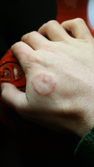 Granuloma Annulare on hand