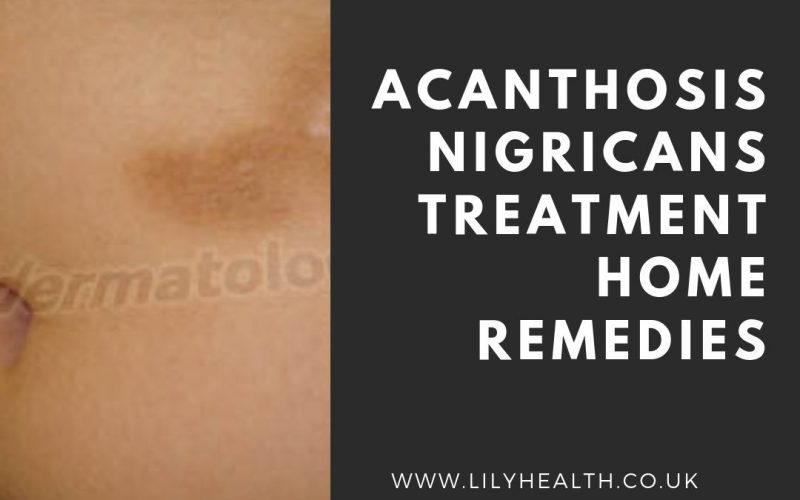 Acanthosis Nigricans Treatment Home Remedies