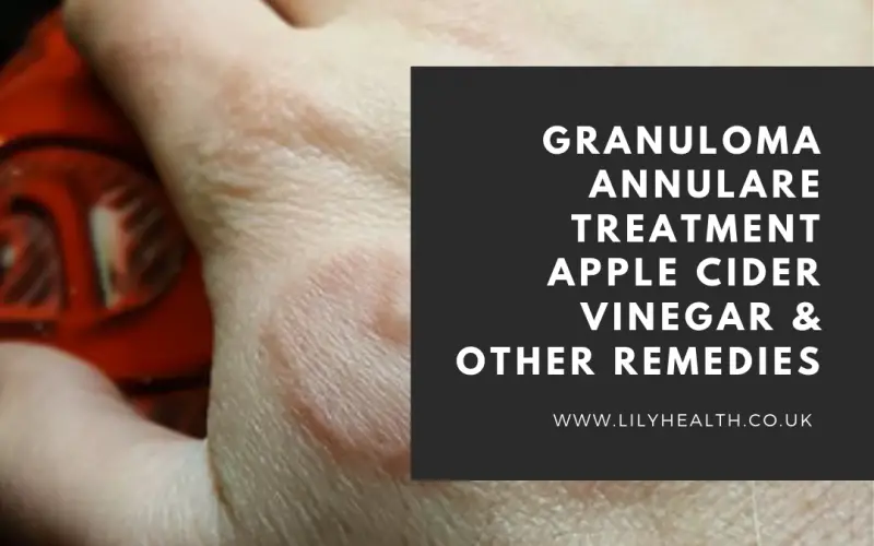 Granuloma Annulare Treatment Apple Cider Vinegar & Other Remedies