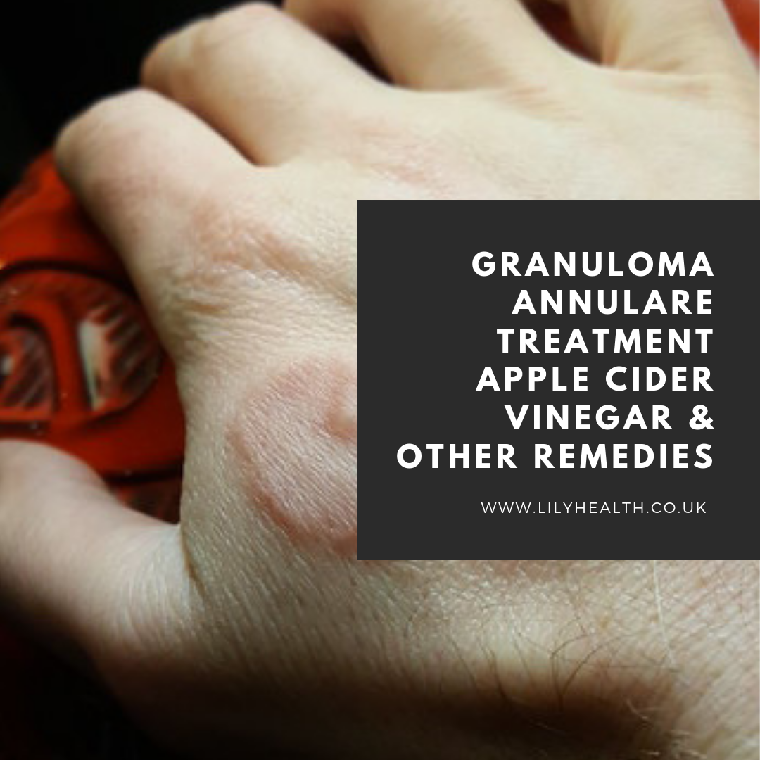 Granuloma Annulare Treatment Apple Cider Vinegar & Other Remedies