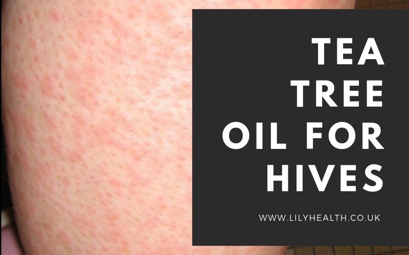 Tea Tree Oil for Hives