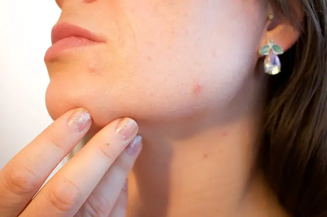 acne on skin